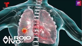 Cáncer de pulmón: 8 síntomas que todo el mundo debería conocer