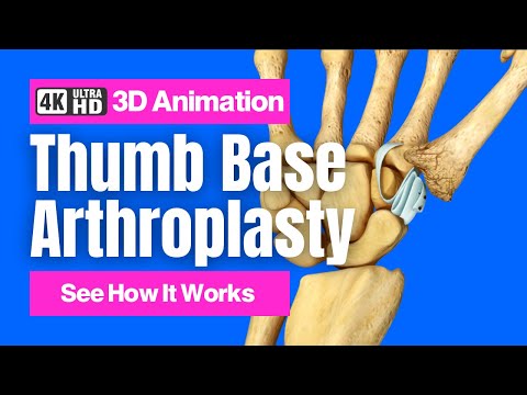 How a Tendon Can Replace an Arthritic Thumb Joint: Thumb Base Arthroplasty