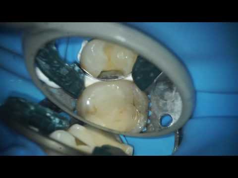 Teflon Floss on Premolar