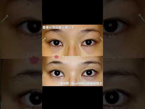 医学科 厚い瞼を薄くする　Roof切除&眼輪筋削ぎ