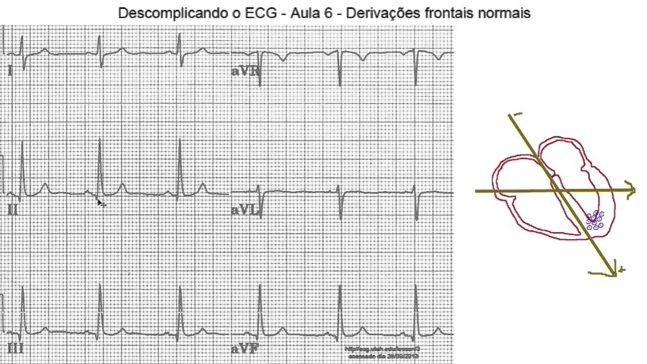 Descomplicando o ECG - Aula 6 - Derivações frontais normais