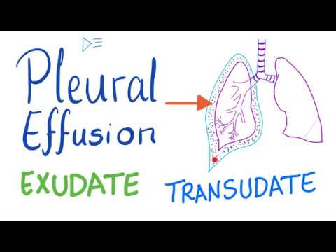 Pleural Effusion - Transudate or Exudate - Causes and Liddle’s Criteria -Pulmonary Medicine Playlist