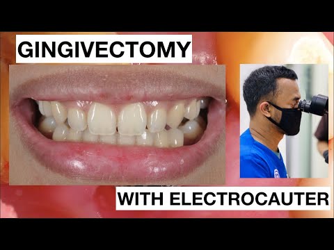 Gingivectomy in simple case Lateral with ElectroCautery