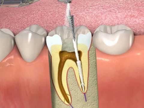 ProPoint- How to obturate a root canal with SmartSeal