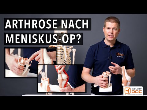 Meniskusoperation  - Führt sie zu einer Arthrose im Knie?