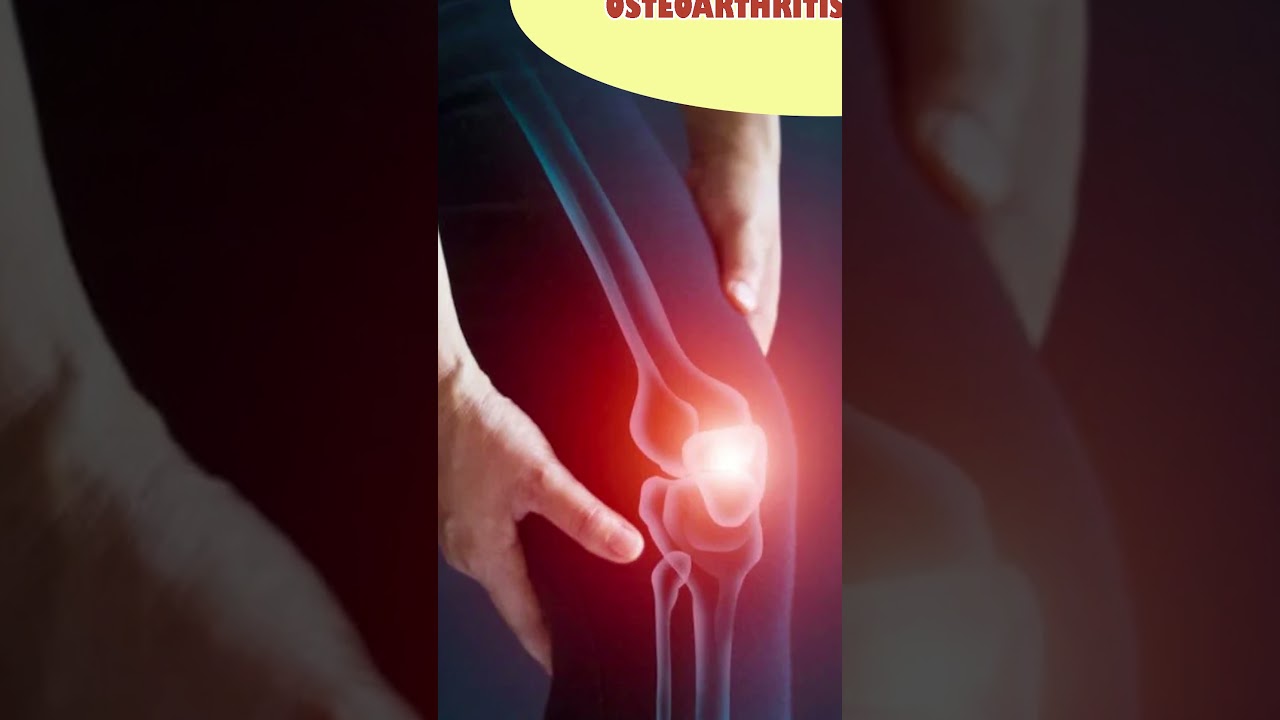 The Importance of Synovial Fluid and Various Treatments of Osteoarthritis | Stem Cell Treatment 