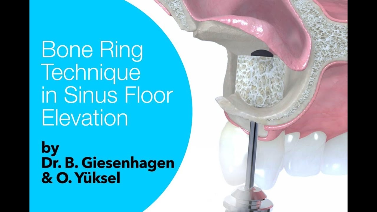 Bone Ring Technique in Sinus Floor Elevation