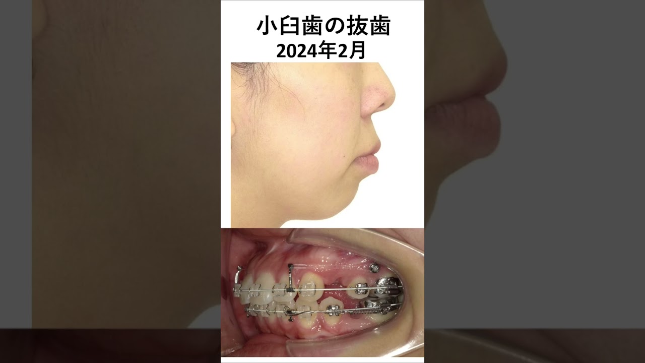 口ゴボの矯正治療 #矯正歯科 #美容 #dentist