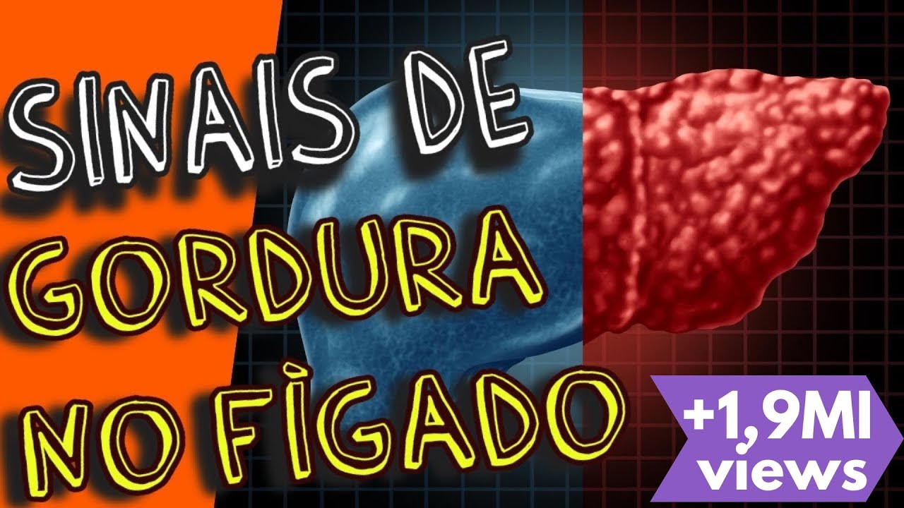 Sintomas de Gordura no Fígado ou Esteatose Hepática (fígado gorduroso)