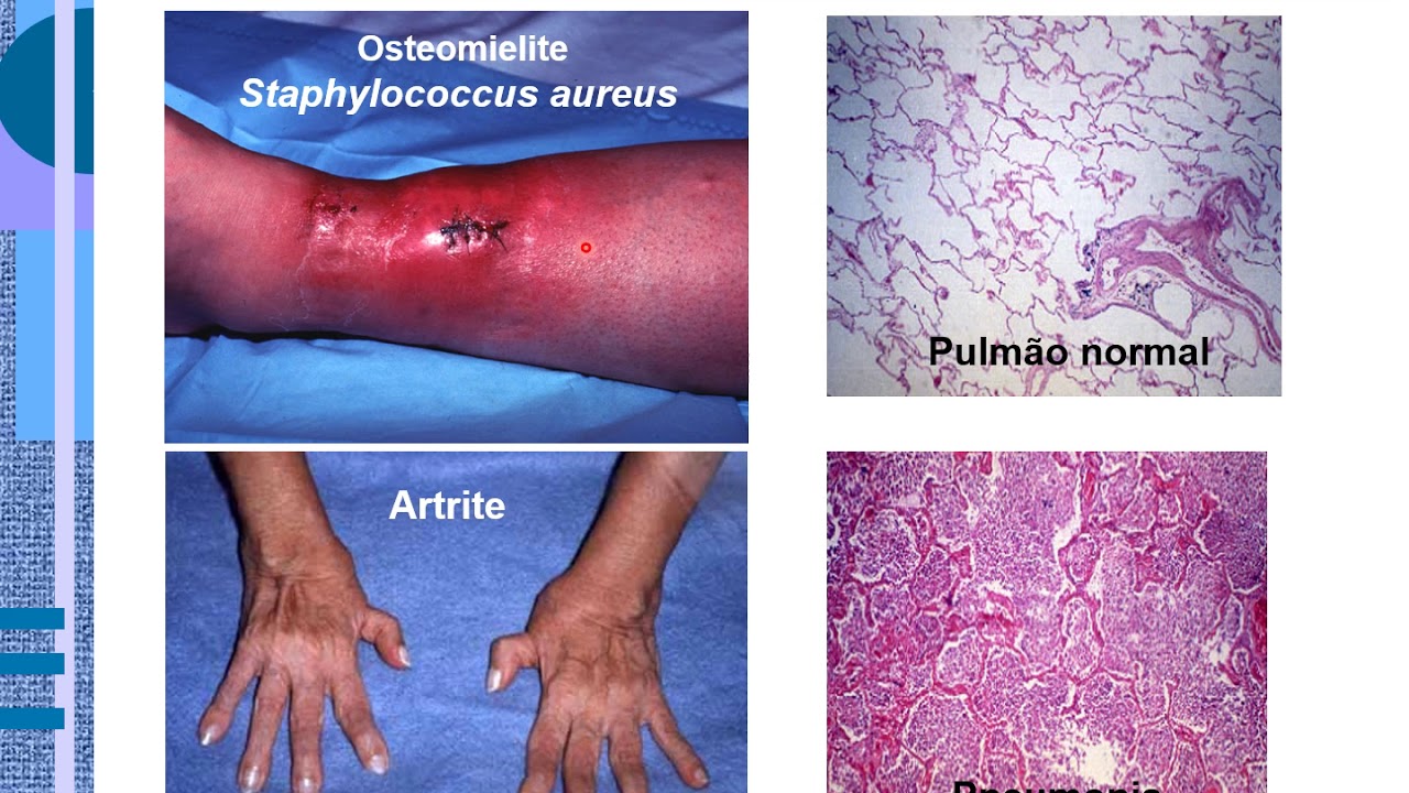 MEDIADORES DA INFLAMAÇÃO   Aula 1