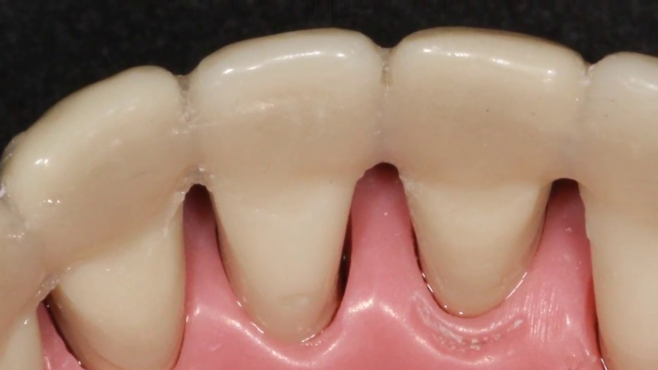Watch FÉRULA PERIODONTAL Now FÉRULA PERIODONTAL