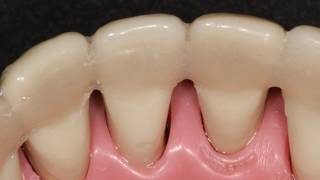 FÉRULA PERIODONTAL