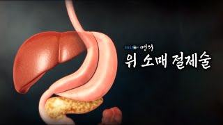 [명의 의학백과📖] 위 소매 절제술