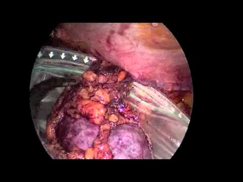 Transvaginal Nephrectomy: Specimen Extraction