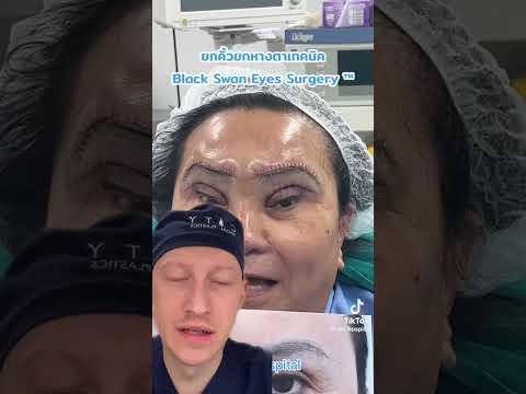 Shocking Black Swan Eye Surgery Trend | Plastic Surgeon Reacts