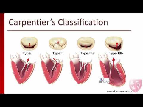 Mitral Regurgitation