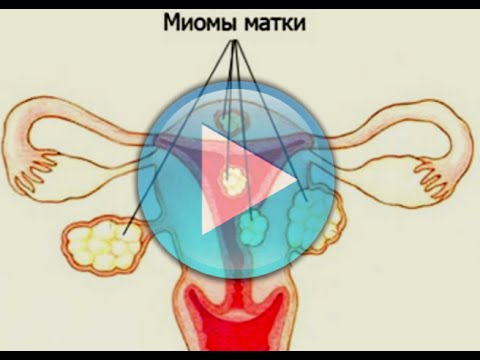 Защемление нервных корешков в шее лечение Остеохондроз 4 степени лечение