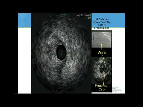 CVI 2019_Thursday 7/18_ PCI how to part 2: CTOs_M. Nicholas Burke, MD