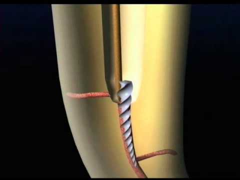 Removal of separated instrument with ultrasonics