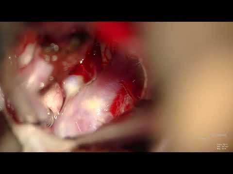 Surgical Clipping of Basilar Top Aneurysm