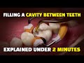Filling A Cavity Between Teeth Class II Composite Resin Procedure To Treat An Interproximal Cavity