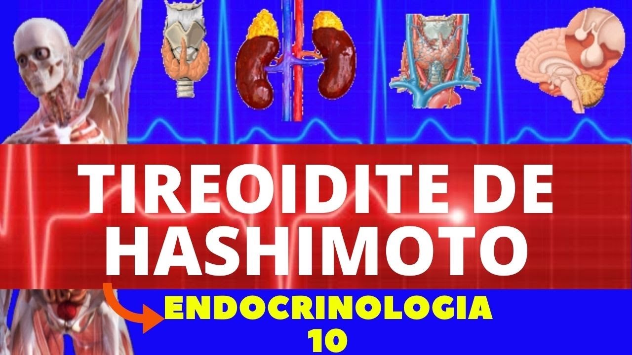 TIREOIDITE DE HASHIMOTO (CAUSAS, SINTOMAS, DIAGNÓSTICO E TRATAMENTO) - ENDOCRINOLOGIA