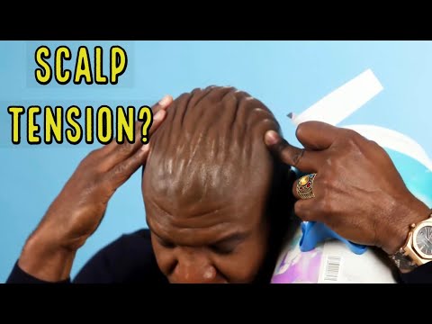 ALL BALDING MEN NEED TO WATCH THIS! SCALP TENSION THEORY!