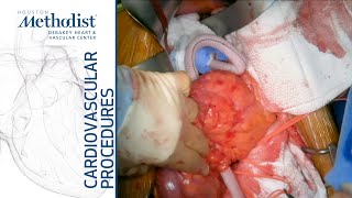 Download Lagu Supraceliac Aorta to Superior Mesenteric Artery Bypass (Alan B. Lumsden, MD, M. Mujeeb Zubair, MD) Thumbnail