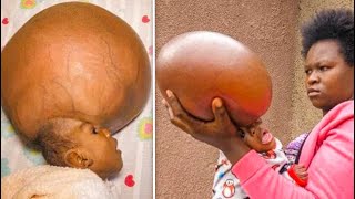 Baby Boy Is Born With Swollen Head, But Doctors Are Shocked When They See Him 6 Years Later