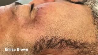 Solar Comedones (Part 3)