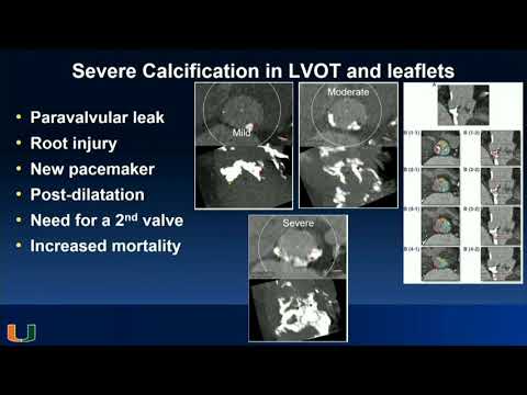 CVI 2019_Saturday, 7/20_ The Boundaries of Structural Heart Therapy III _Mauricio Cohen, MD