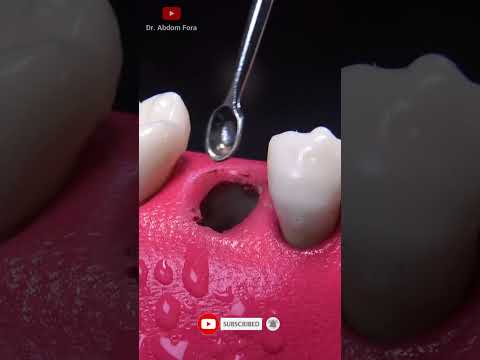 Fractured tooth extraction in 4K #Shorts