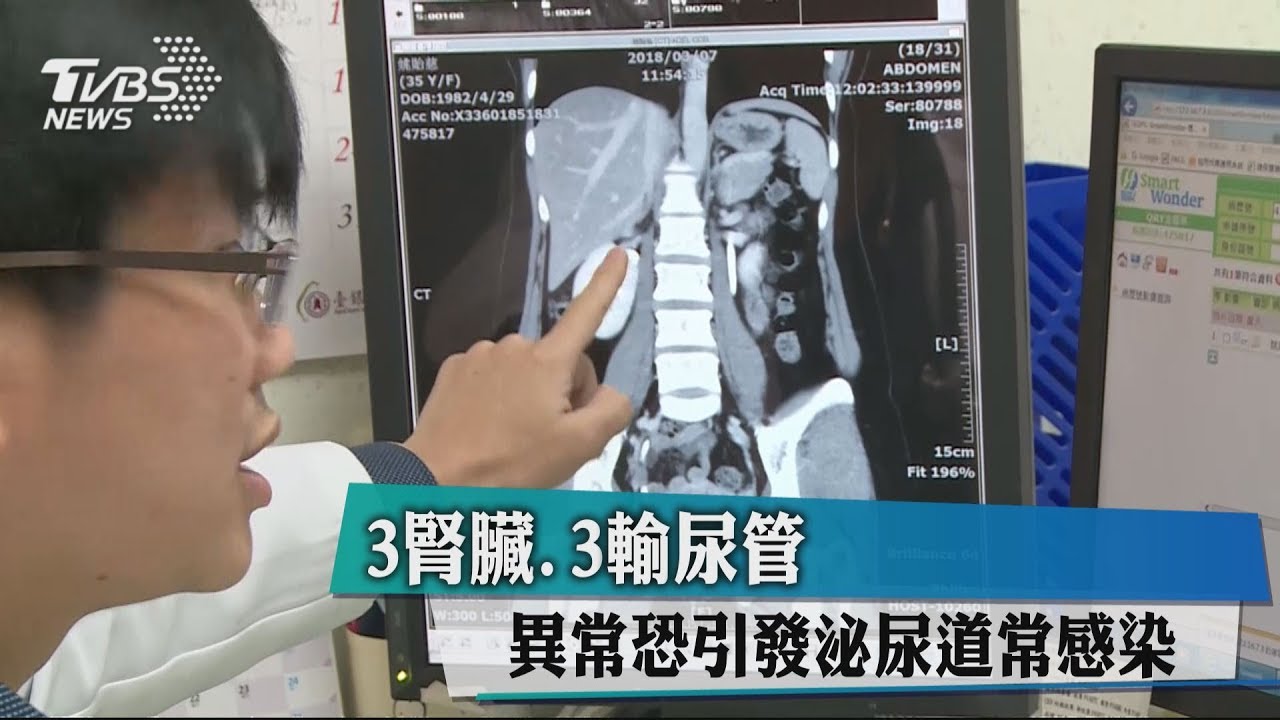 「3腎臟、3輸尿管」 異常恐引發泌尿道常感染