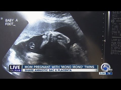 Orrville mom delivers rare set of mono mono identical twin girls