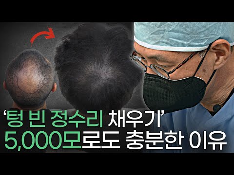 모두가 기피하는 정수리 모발이식, 5000모로도 가능할 수 있다