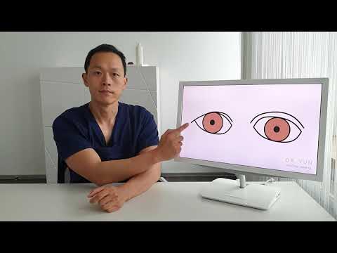 Was passiert bei einer Lidstraffung? | Dr. Yun | Plastische Chirurgie Frankfurt