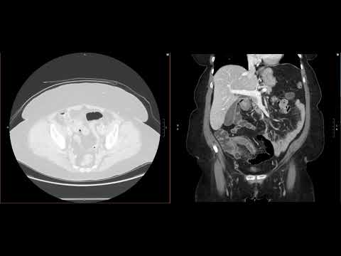 Abdominal Imaging Call Prep Cases: Perforated Appendicitis (CT) Case 1 Discussion