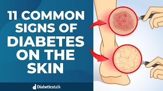 11 Common Signs of Diabetes on The Skin