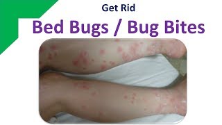 Get Rid Bed Bugs / Bug Bites - Home Remedies for RED and  ITCHY Bug BITES