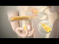 Penile Implants for Erectile Dysfunction - Dr. Sanjay Razdan