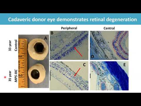 CRF Eye Donation Program