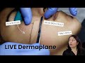 LIVE DERMAPLANE Q&A WITH MASTER AESTHETICIAN | #Skincare