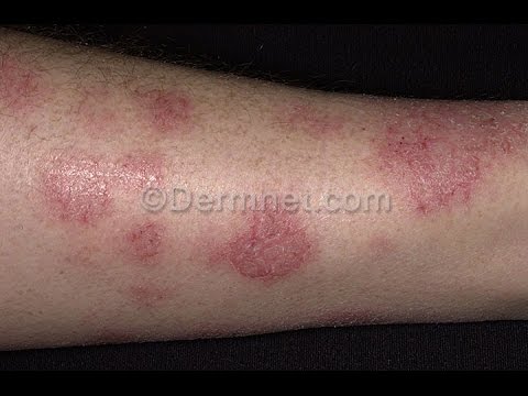Il piano di cura di bambini con dermatite atopic Con psoriasi prendono in istituto superiore militare