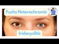 Fuchs Heterochromic Iridocyclitis (FHC) - What is this fascinating condition? Eye Dr Explains, 2023