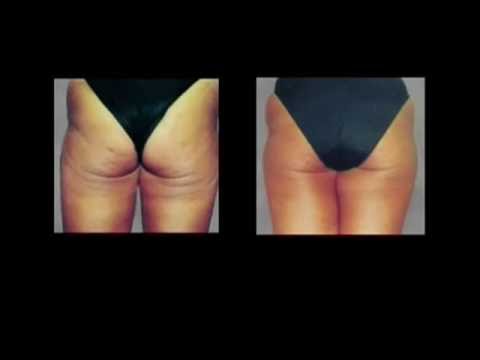 Trattamento delle articolazioni nelle donne Preparazioni per entrare nellarticolazione del ginocchio