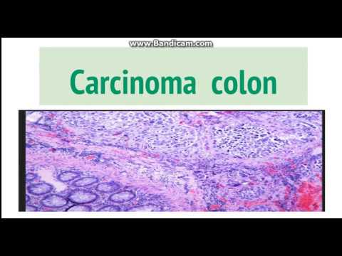 Vocal cord papilloma voice therapy
