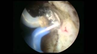 Μέθοδος Turis - Αιμόσταση