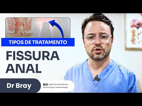 LASER para FISSURA ANAL CRÔNICA - Dr Fernando Bray
