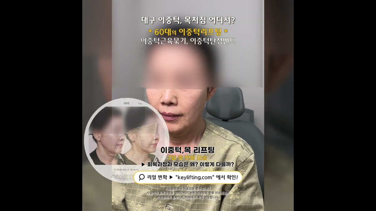 60대의 이중턱, 목 리프팅