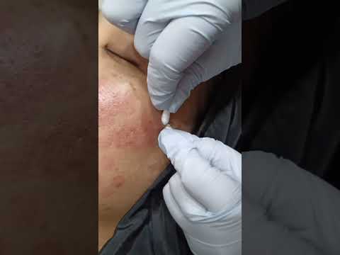 Safe Milia & Oil Seed Removal | Precision Clinical Extraction